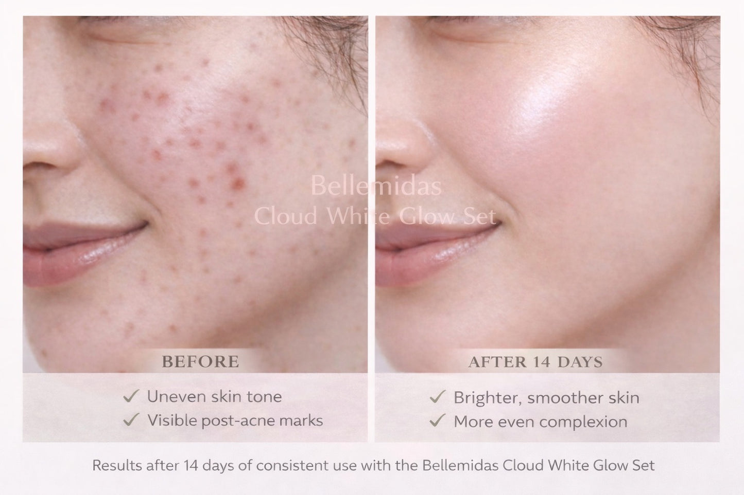 Bellemidas Cloud White Glow Set – Fade Dark Spots. Reveal Radiant Skin                                                               ✔ Targets post-acne marks  
✔ Brightens uneven skin tone  
✔ Day & Night complete routine ⭐⭐⭐⭐⭐ 10,000+ Verified Customers